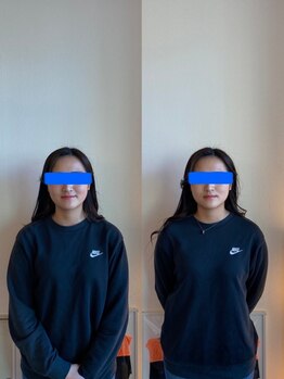 根津整骨院/【小顔矯正】ビフォー→アフター