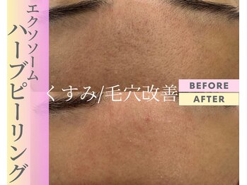 Cスキンケアクリニック 麻布店/ハーブピーリングBeforeafter