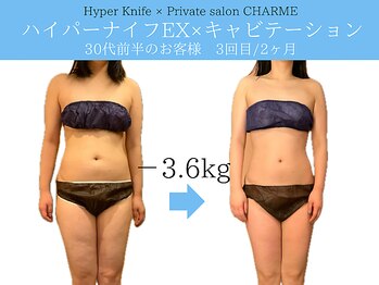 シャルム(charme)/ブライダル痩身♪ハイパーナイフ