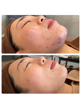 サロン ド フェイス モアナ(Salon de Faith Moana)/フォト光フェイシャル