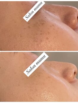 ムム(mumu)/シミ・しわ・ぼやぼやシミ