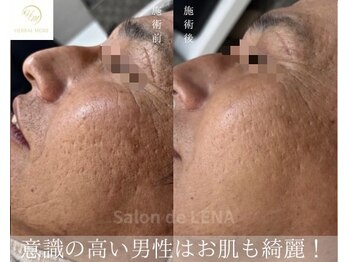 サロン ド レナ(Salon de LENA)/ハーブピーリング サロンドレナ