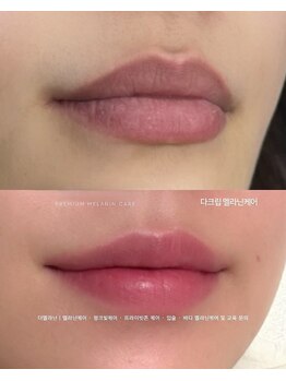 ドクターメラニン ラボ トーキョー 渋谷(Dr. Melanin Labo TOKYO)/自然な仕上がり