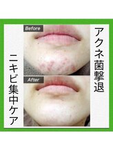 望月整体院/アクネ菌撃退