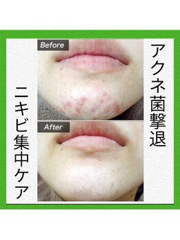 望月整体院/アクネ菌撃退