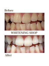 whitening shop 守谷店/ホワイトニングショップ守谷店