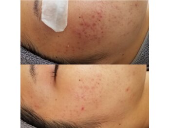 モモ(Momo.)/お肌ケアにはハーブピーリング