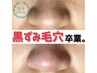 高濃度水素除去+毛穴エクストララクション♪頑固な黒ずみ/詰まった毛/角栓