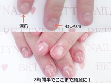 ベティネイル 八王子店(BETTYNAIL)/深爪補正10本カラー込み¥16720