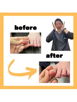 とくしま整体院 藍住院/巻き爪