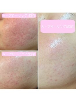 ガーデン(Garden)/ニキビケア　ハーブピーリング