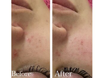 MMK/ハーブピーリングで赤みスッキリ