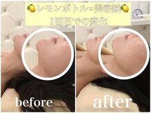 アキュモンド 渋谷院(acumond)/《たるみもたつき解消》40代変化