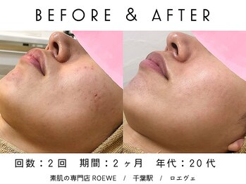 ロエヴェ(ROEWE)/ニキビ改善・毛穴ケア・肌質改善