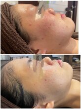 ミラヴィエ(Miravie)/肌質改善プログラム10回