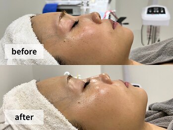 ウェイビーズ エステ(wavy's.esthetic)/【ビフォーアフター】ツヤ美肌