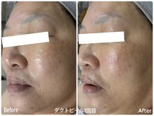 ブロッサム(Blossom)/ダクトピールお試し体験