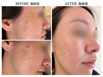リエラ(Liella)の写真/はじめてのシミケアにも◎【シミケア無料カウンセリング★￥0】当日施術もOK！話題のホワイトラボ取扱店♪