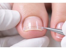 リフト(Re:ft)の雰囲気（痛みが少ない　切らない　特殊なプレートを使用した巻き爪補正）