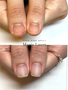マリーロール 梅田店(Marie Laure)/自爪育成/深爪矯正/ネイルケア