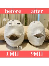 ロータス ビューティー(LOTUS Beauty)/石膏パックビフォーアフター