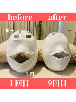 ロータス ビューティー(LOTUS Beauty)/石膏パックビフォーアフター