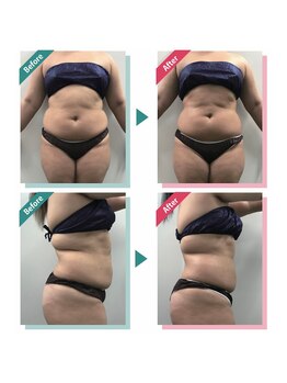 レニフォーメン(reni for men)/【お腹集中】