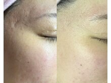 ドゥナ(DUNA)/7日間肌コース