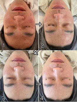 カランコエ(KALANCHOE)/長年のお悩みも継続で改善