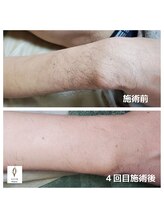ヴォアール 名古屋店(VOIR)/ひじ下脱毛