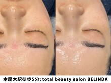 ベリンダ(BELINDA)/セルマンピーリング