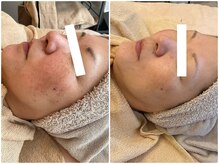 クラージュ/メソポレーションも人気です！