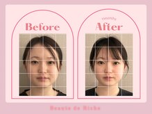 ボーテドリッシュ(Beaute de Riche)の雰囲気（トータル美容整骨（顔・身体）初回Before→11ヶ月後after比較）