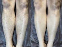 ミスターアンドミス脱毛専門店 難波店(Mr.&Ms.脱毛専門店)/脚脱毛☆before after