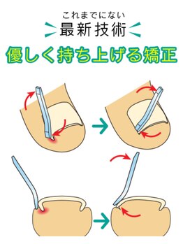 やまと鍼灸整骨院 整体院/最新技術の巻き爪矯正