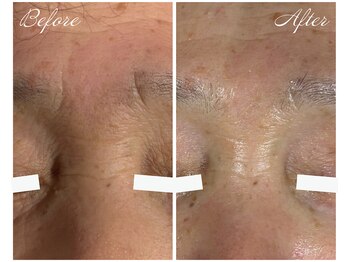 サラスヴァティー(SARASVATI)/眉間・目元のシワ改善★60代女性