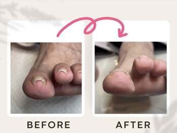 ドクターネイル爪革命 恵庭店/巻き爪ケア