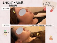 レモンボトルでフェイスラインかなりスッキリ小顔です♪