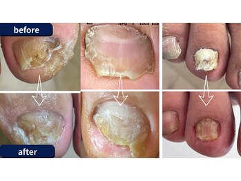 貴方の大切な元の爪に戻ります。