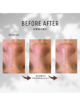 ヴィオラ 松戸店(Viola)/毛穴の黒ずみでお悩みの方に