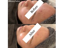 エムビューティーサロン(M Beauty Salon)の雰囲気（【1回での変化！】ニキビ・乾燥・くすみ・毛穴）