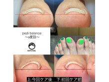 ケイト ネイル(KEITO NAIL)の雰囲気（巻爪ケアジェルpedi balance正規取扱店☆本当に本当にオススメ♪）