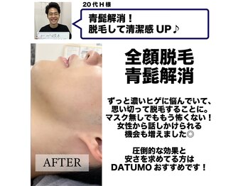ダツモ 新宿御苑店(DATUMO)/メンズ脱毛体験談/新宿/ヒゲ脱毛
