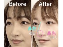 ラプリナーゼ 吉祥寺店(Raplit Nase)/隆鼻＋輪郭小顔矯正40分10回