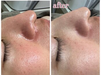 エステティックサロン ベルエトワール住吉店/ハイドロヴィーナス