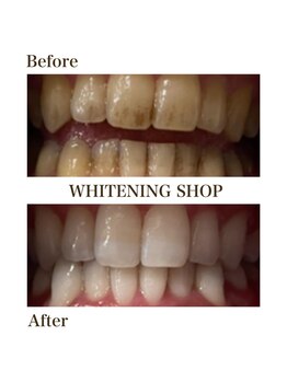 ホワイトニングショップ 春日井店(whitening shop)/beforeafter 10回券終了