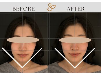 チョコバリ 渋谷店(chocobari)/小顔×リフトアップ(美容鍼)20代