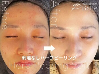 ベル 静岡(Belle)/静岡/ハーブピーリング/毛穴