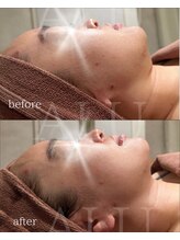 アルフォービューティー 難波店(ALU for beauty)/オンダリフト症例