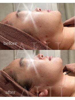 アルフォービューティー 難波店(ALU for beauty)/オンダリフト症例